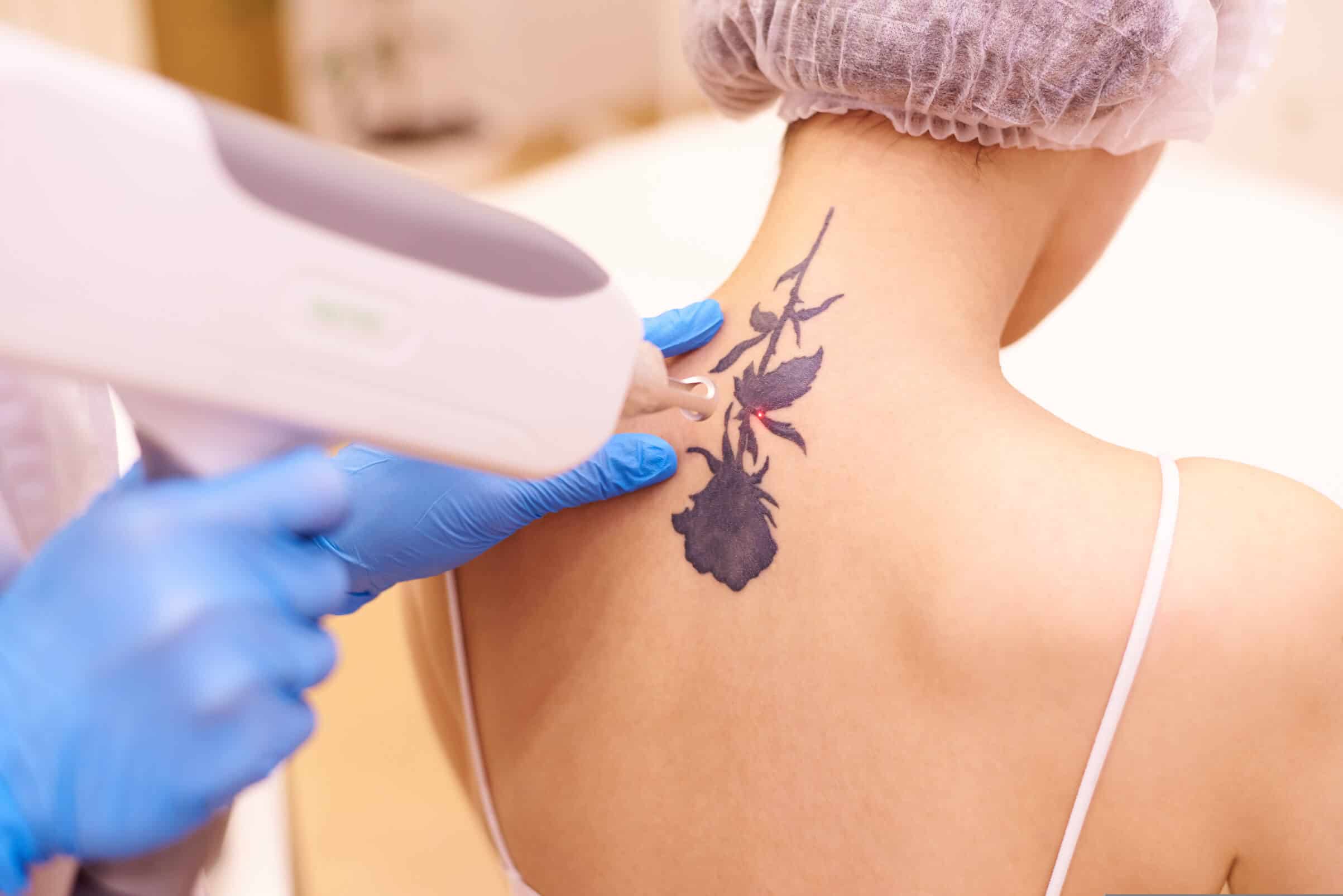 tattoo-removal-treatment-in-kolkata